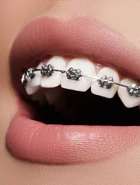 Woman’s mouth with traditional braces in Castle Rock, CO