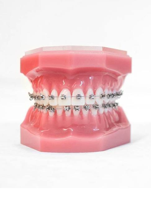 Model of teeth with traditional braces in Castle Rock, CO