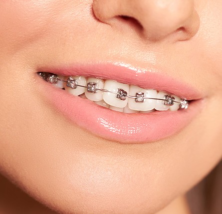 Image of crooked teeth and braces