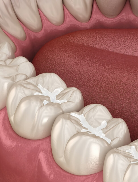 Illustrated row of teeth with dental sealants