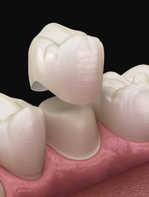 Illustrated dental crown being fitted onto a tooth