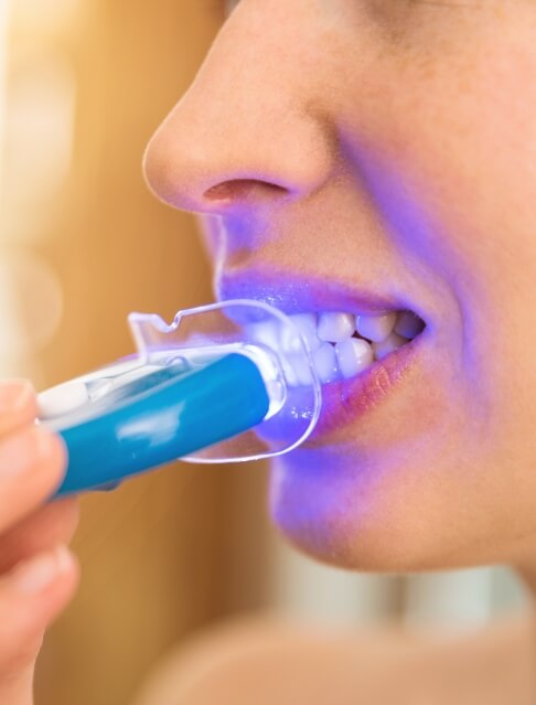 Close up of person getting their teeth professionally whitened