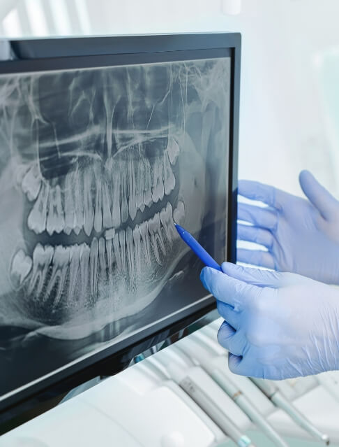 Gloved hand pointing to x ray of teeth on computer screen