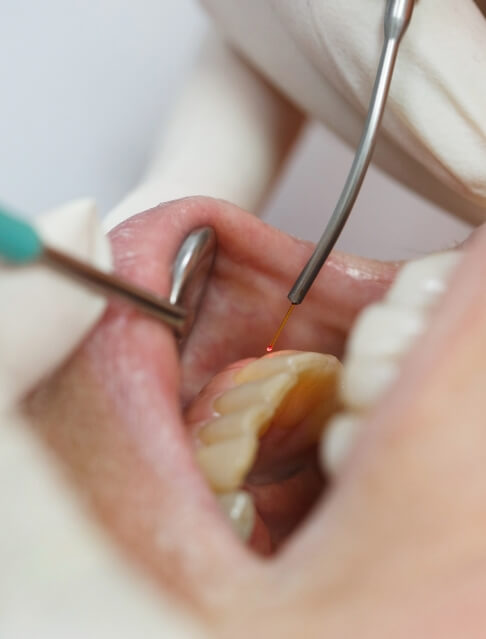 Close up of dentist using soft tissue laser to treat gums