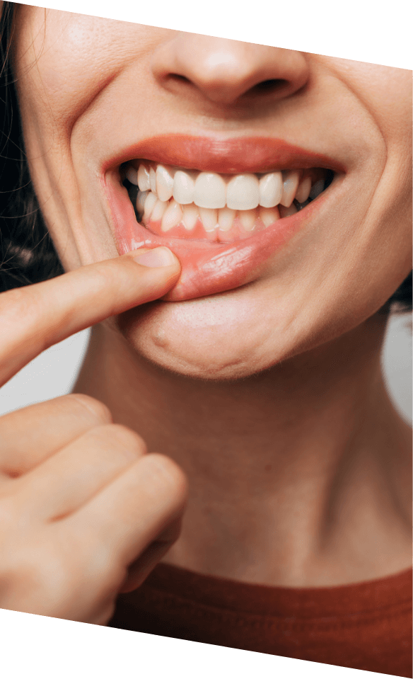 Close up of person pointing to their gums after gum disease treatment in Castle Rock