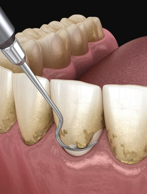 Illustrated dental instruments clearing plaque from teeth