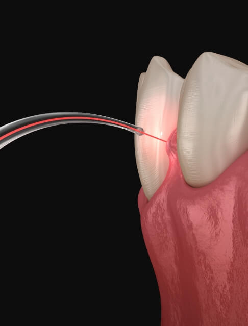 Illustrated dental laser treating gum disease