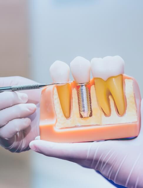 Dentist pointing to a model of a dental implant