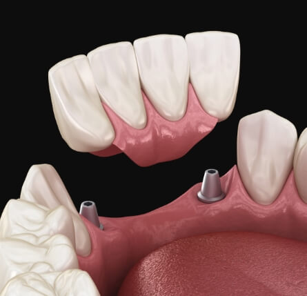 Illustrated dental bridge being placed onto two dental implants