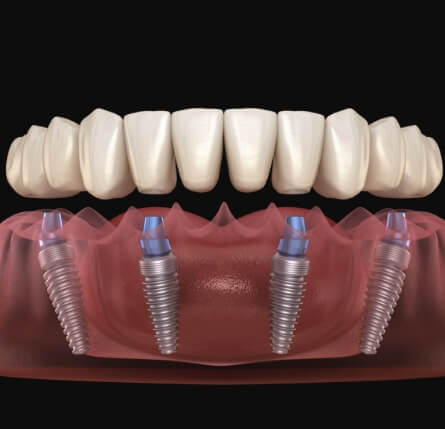 Illustrated full denture being placed onto four dental implants