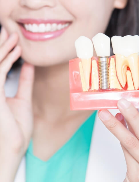 Dentist holding a model of a dental implant