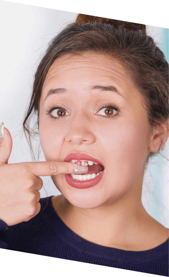 Young woman pointing to her broken teeth before restorative dentistry in Castle Rock