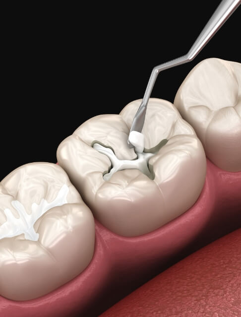 Illustrated white filling being placed inside of a tooth