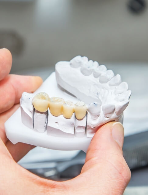 Hand holding a model of the jaw with a dental bridge replacing three of the teeth