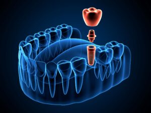 Illustration of a blue transparent lower arch with red dental implant on a dark background